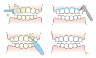 歯面清掃